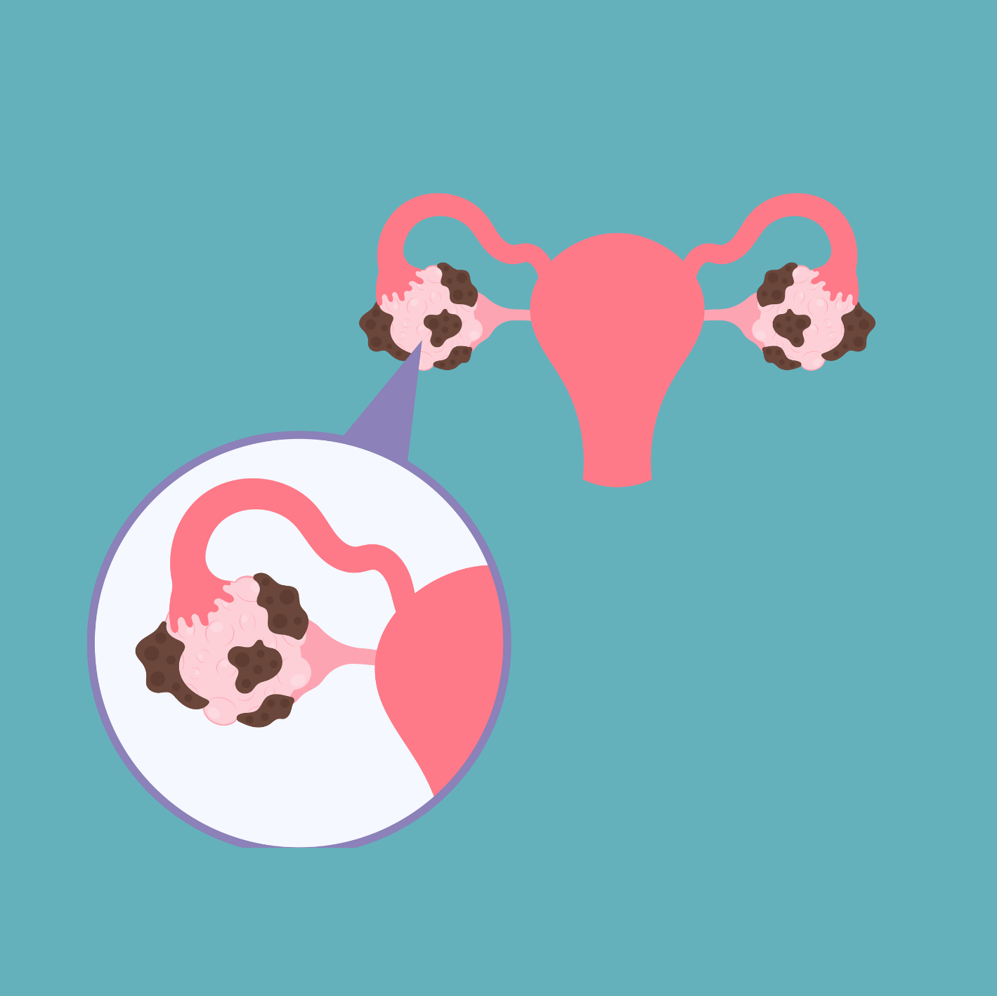 ¿Qué es la endometriosis?